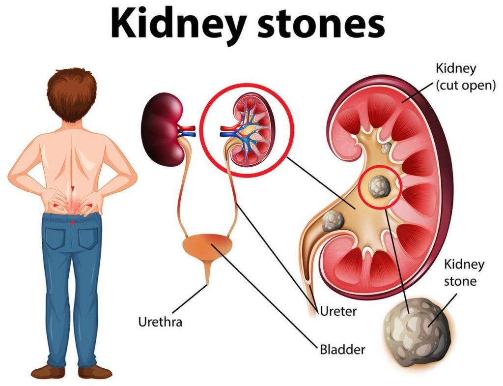 How to Dissolves Kidney Stones In 7 Days Naturally